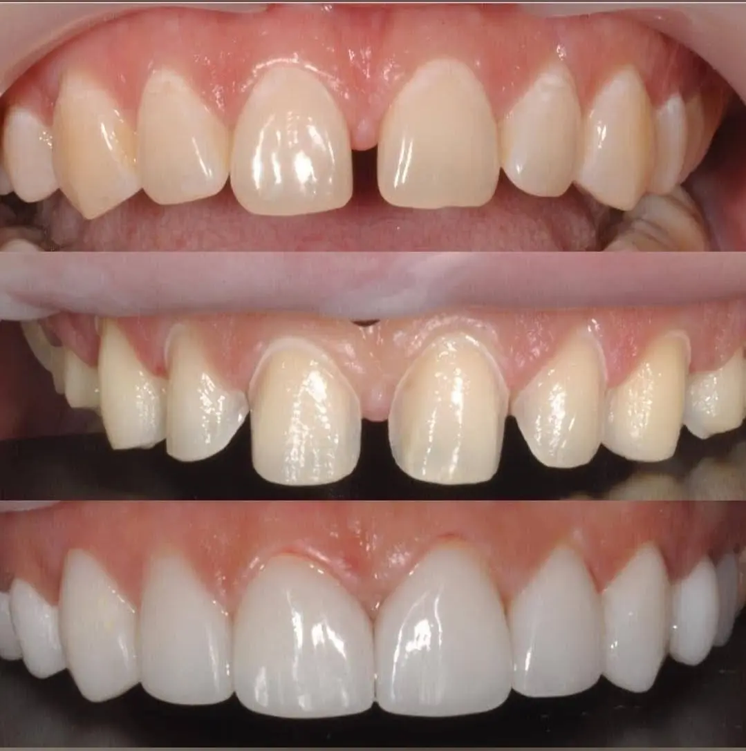 Veneers E-max